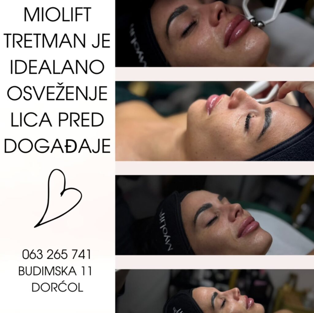 Miolift tretman je idealno osvezenje lica pred dogadjaje